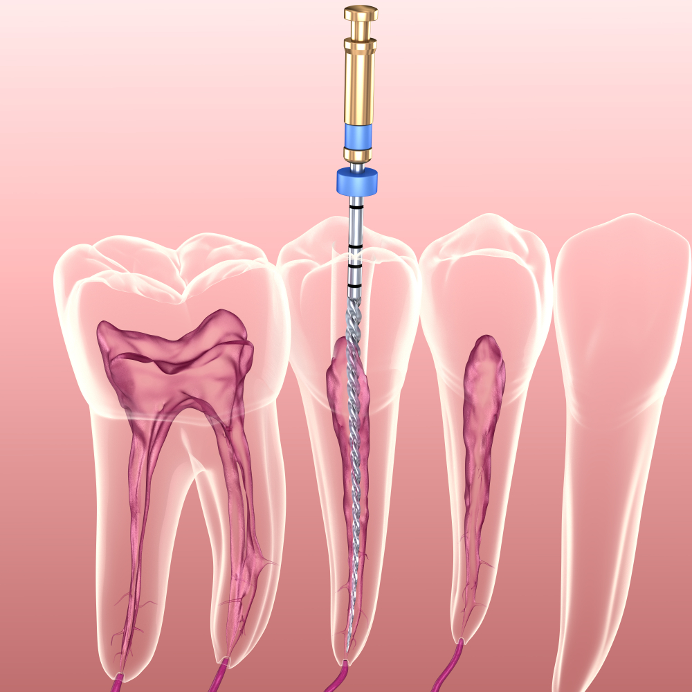 endodontics